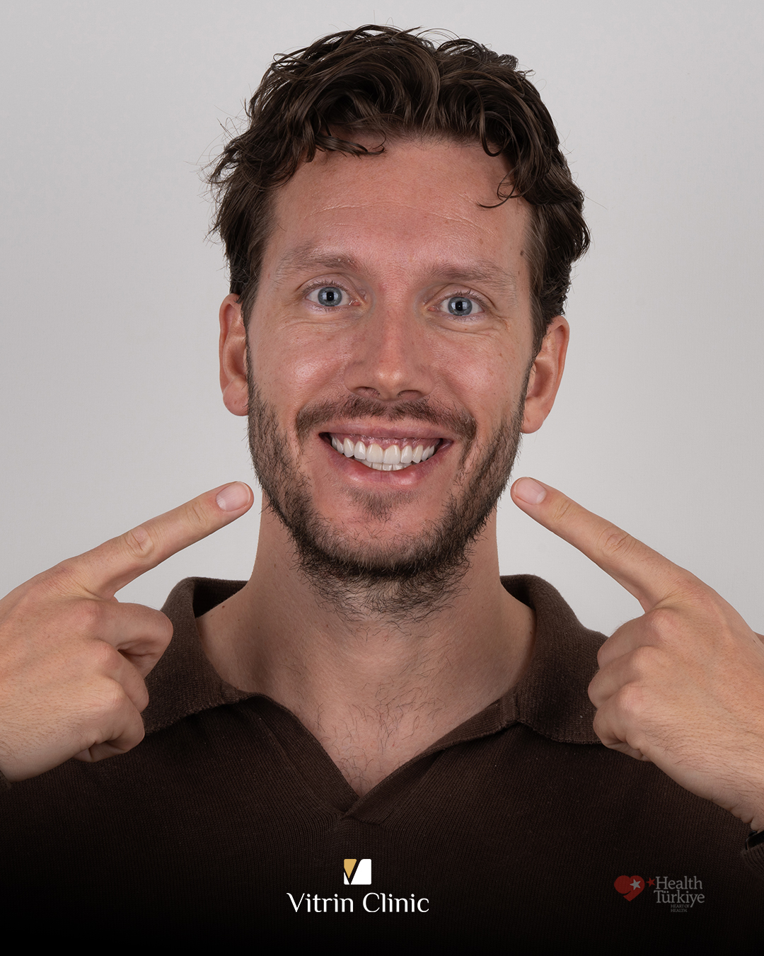 Faccette per denti gialli